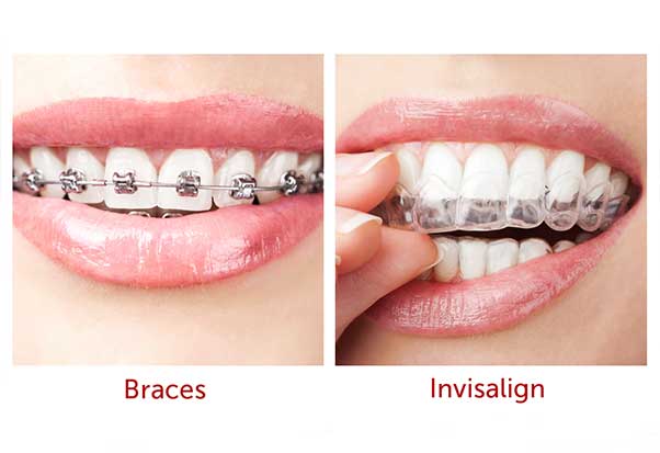 How Do Invisalign® Aligners Work ?