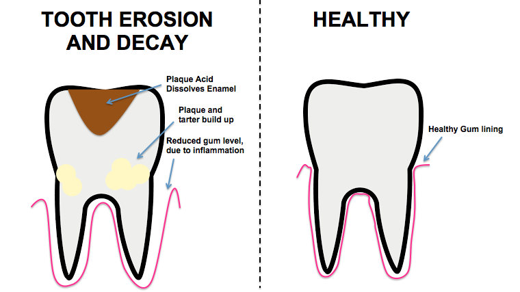 What is a cavity? From plaque to tooth decay