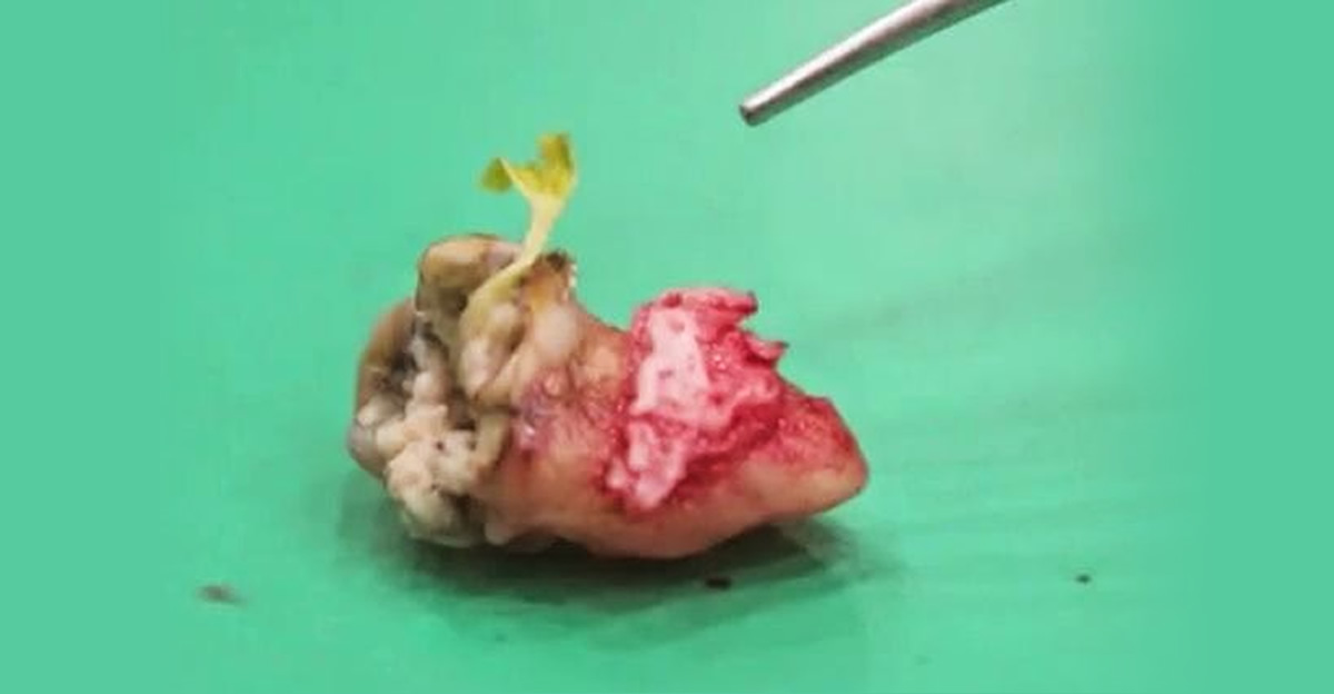 guava seed growing in tooth
