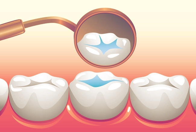 Do Dental Sealants Wear Off?