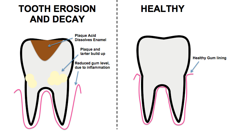 cavities between front teeth