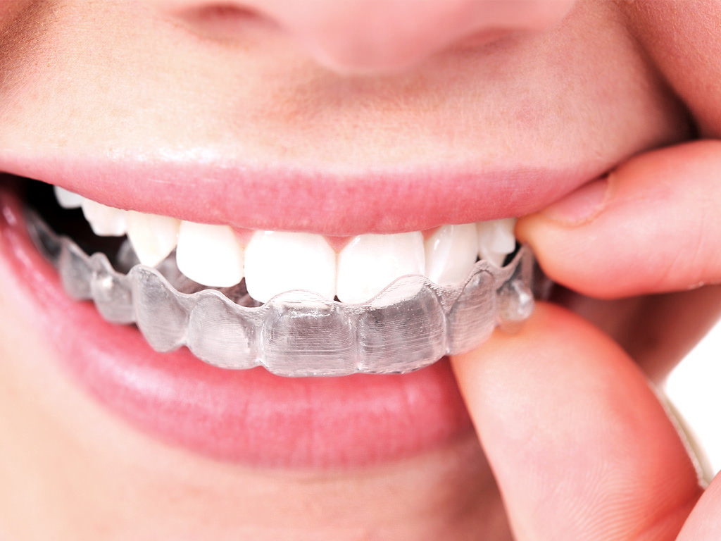 Smile Direct Club vs. Invisalign: Is There a Clear Winner? - Dental Health  Society