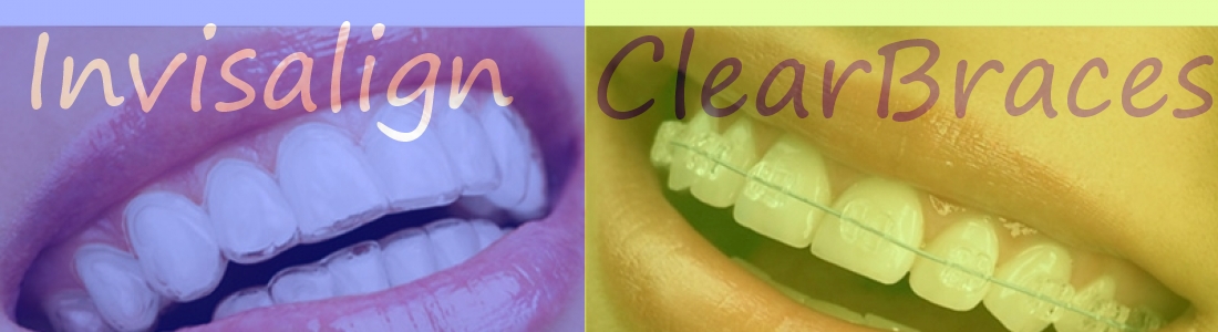 Ceramic Braces Vs. Invisalign