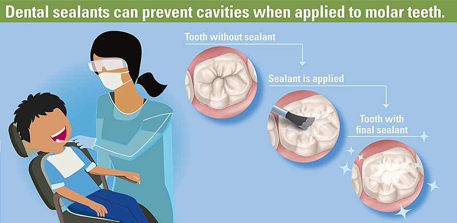 dental-sealant-procedure-youtube