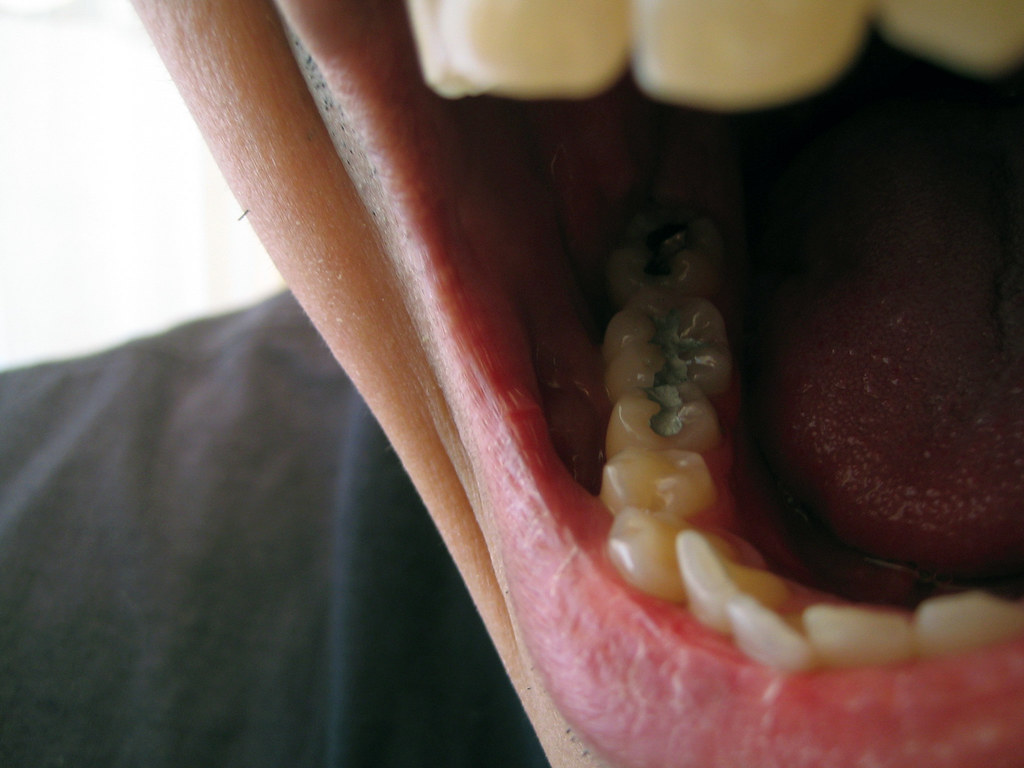 man showing mouth with several cavities filled