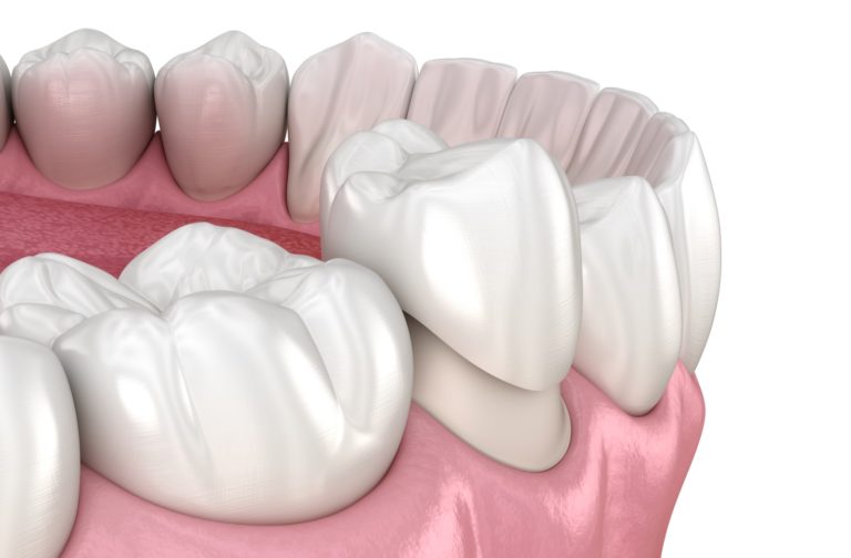 What Are “Prepless Crowns” — and Are They Really Different from Traditional Crowns?