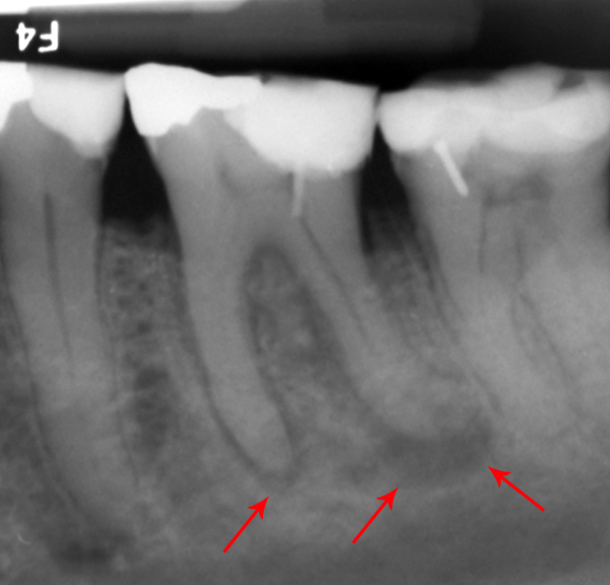 What Causes a Tooth to Abscess?