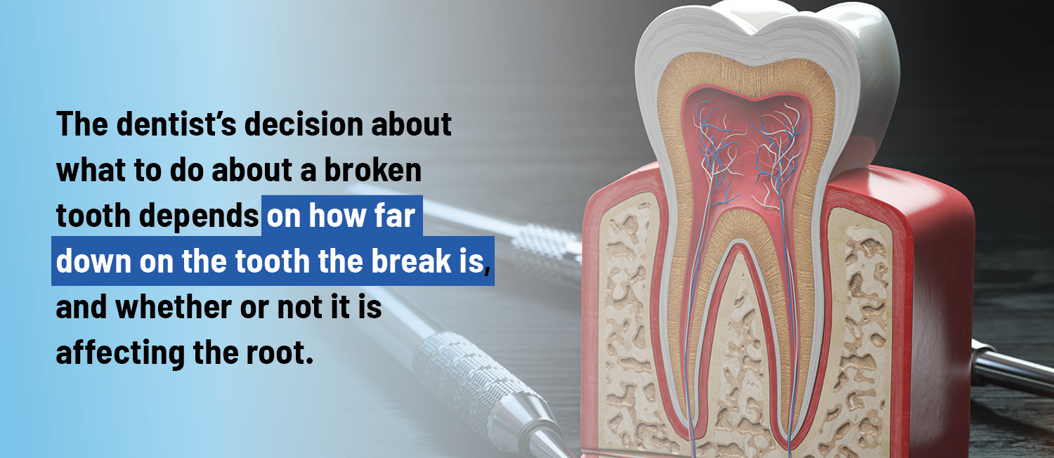 The dentist’s decision about what to do about a broken 
tooth depends on how far 
down on the tooth the break is,
and whether or not it is
affecting the root. 