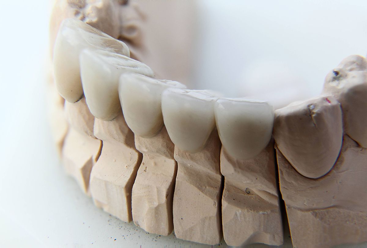 Dental Crowns: Issues and Concerns