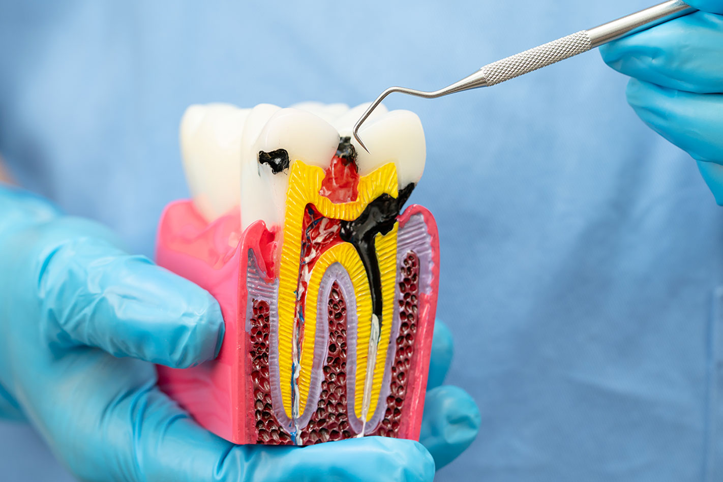 Filling, Crown, or Root Canal? How Dentists Decide Which Treatment You Actually Need