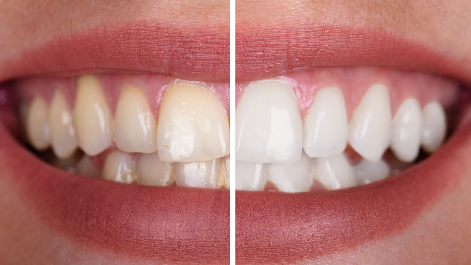 Before and after images of teeth cleaned by a dentist