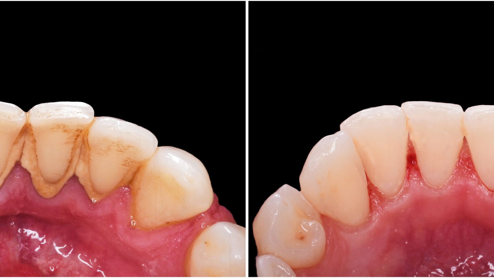 Before And After Photo Of Dentist Cleaning Teeth 