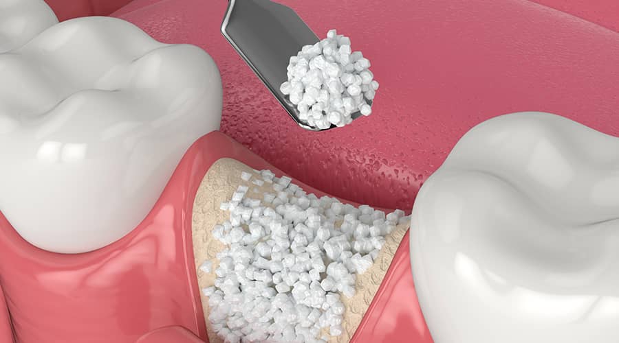 Do I Really Need a Bone Graft Before Implants?