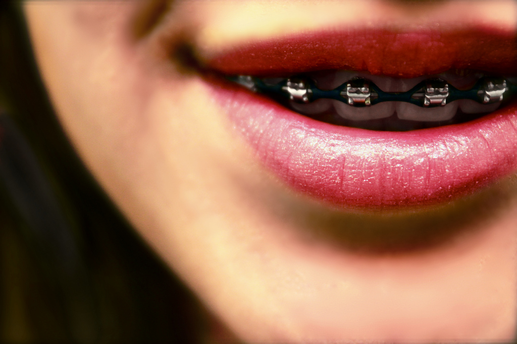 girl with braces to widen smile