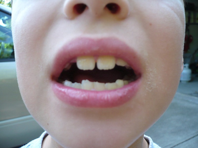 Chipped teeth on boy https://creativecommons.org/licenses/by-nc-sa/2.0/legalcode