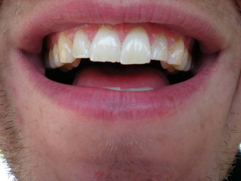 Chipped tooth requiring emergency dental care