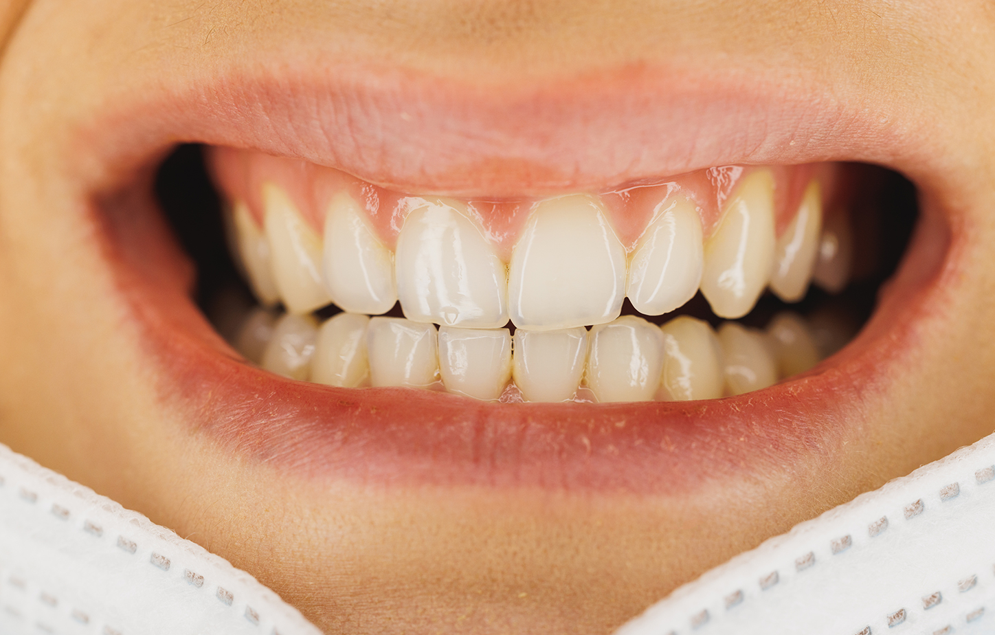 “Why Are My Teeth Turning Yellow Even Though I Brush? (And What to Do Before Whitening)”