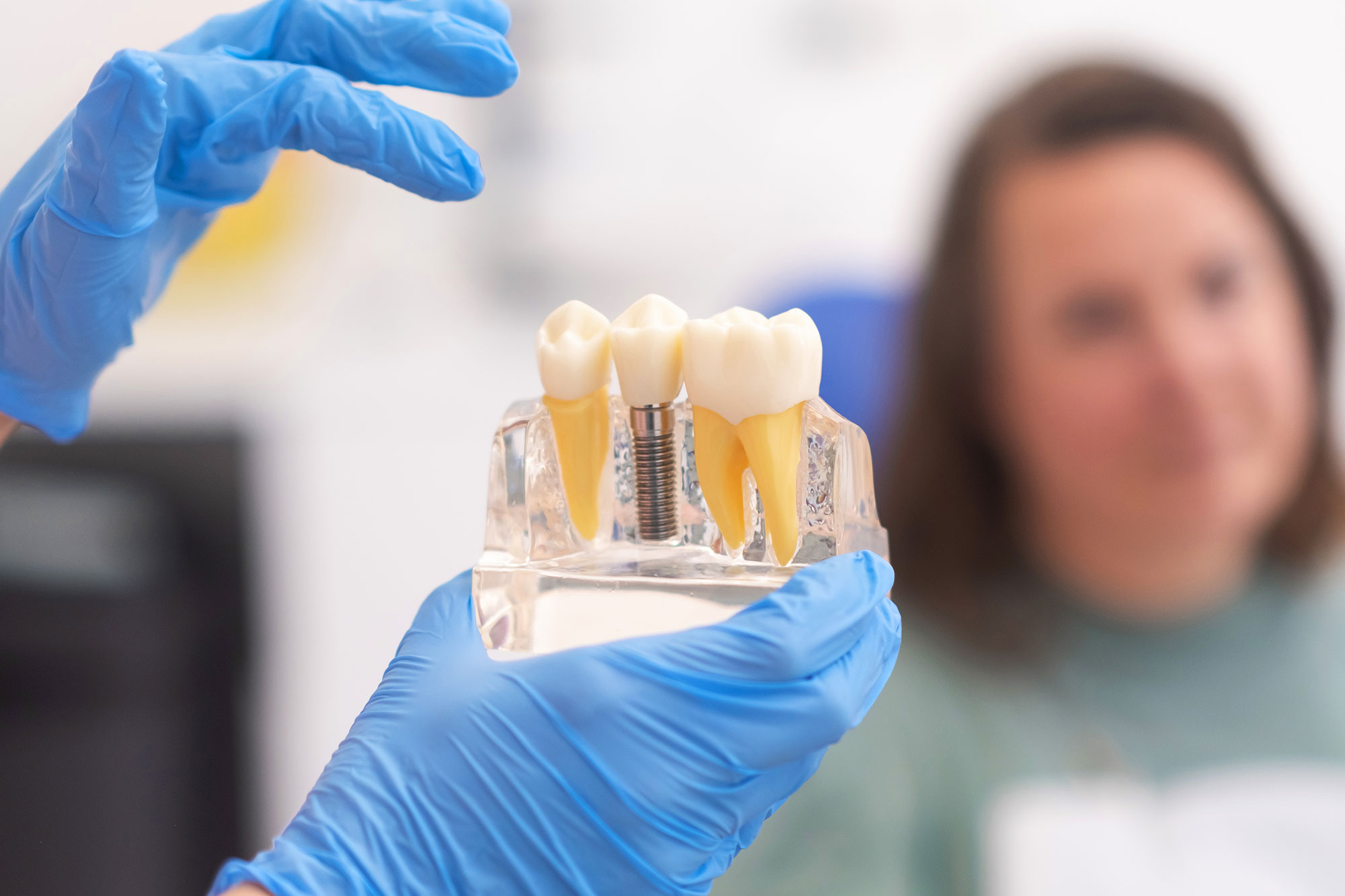 How Long Do Dental Implants Really Last? What Patients Should Know