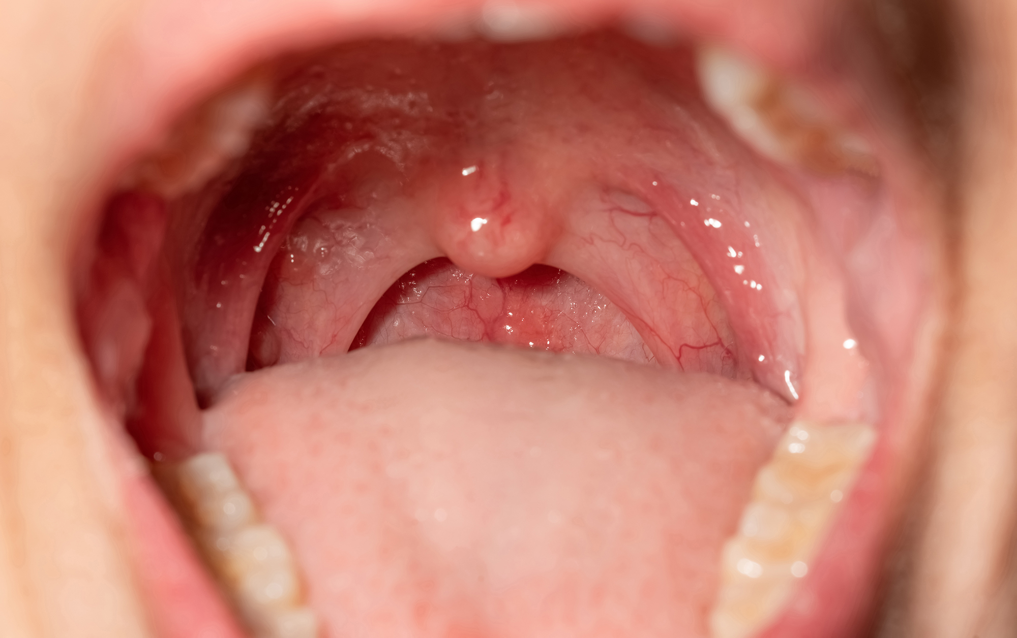 What Is a Frenectomy — and When Do Dentists Recommend One?