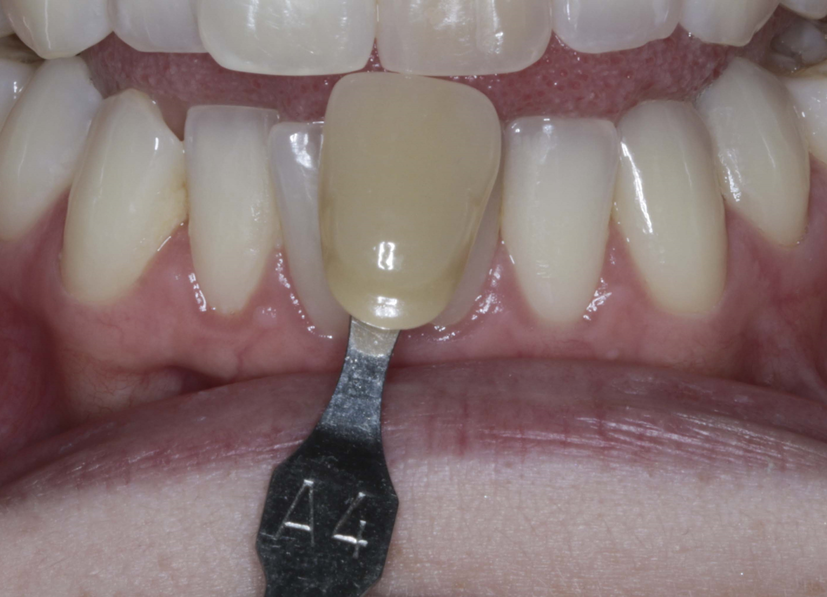 toothpaste to remove stains from porcelain crowns