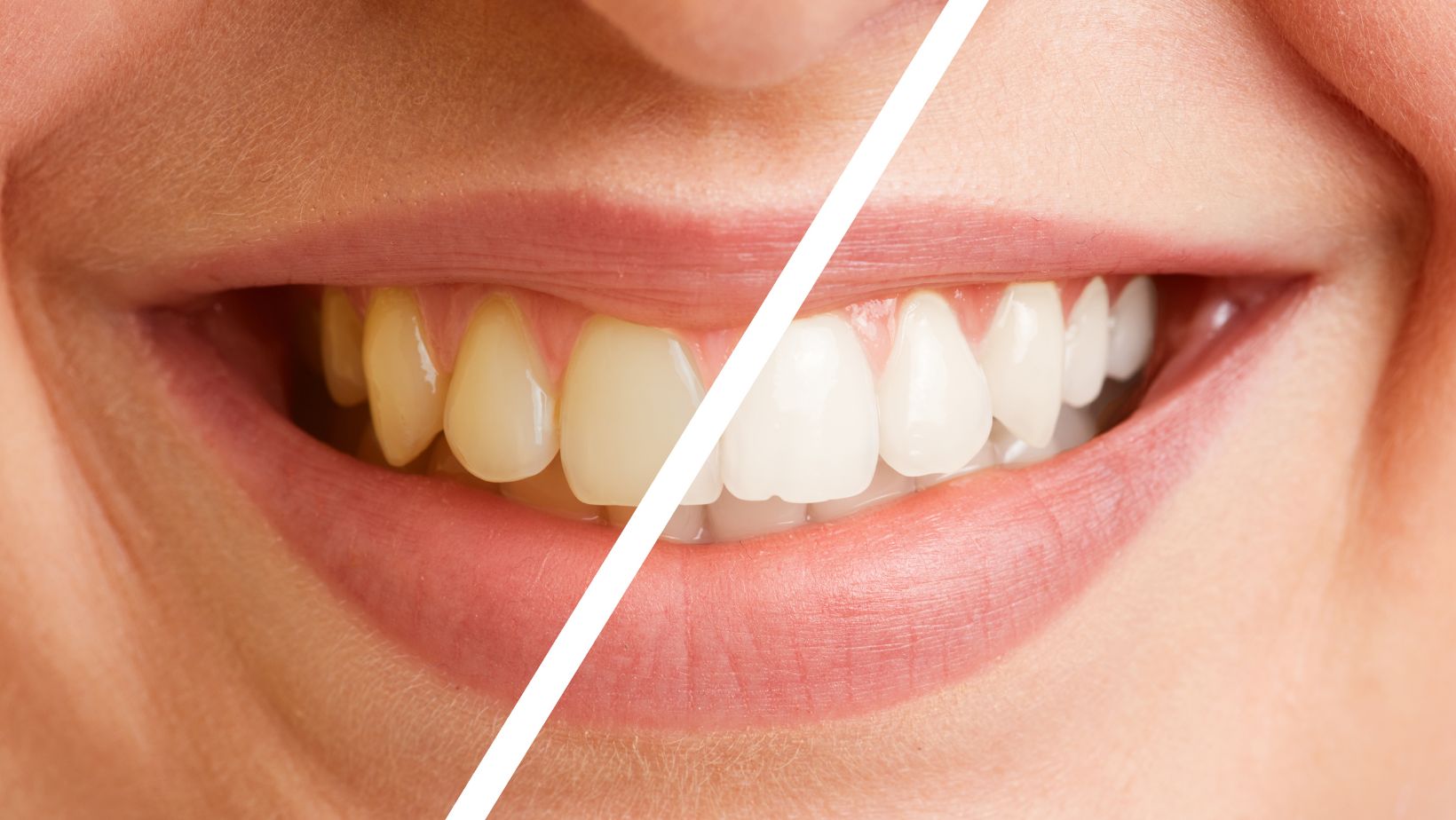 Teeth Deep Cleaning Before And After