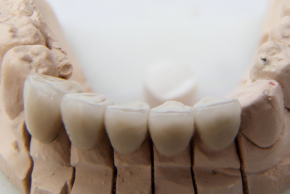 dental crowns on model of mouth