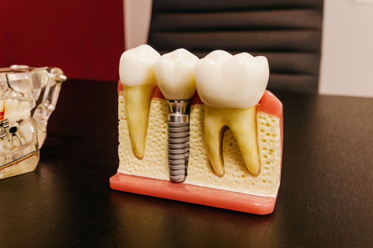 Model of gums cross-section , showing dental implant crown and abutment