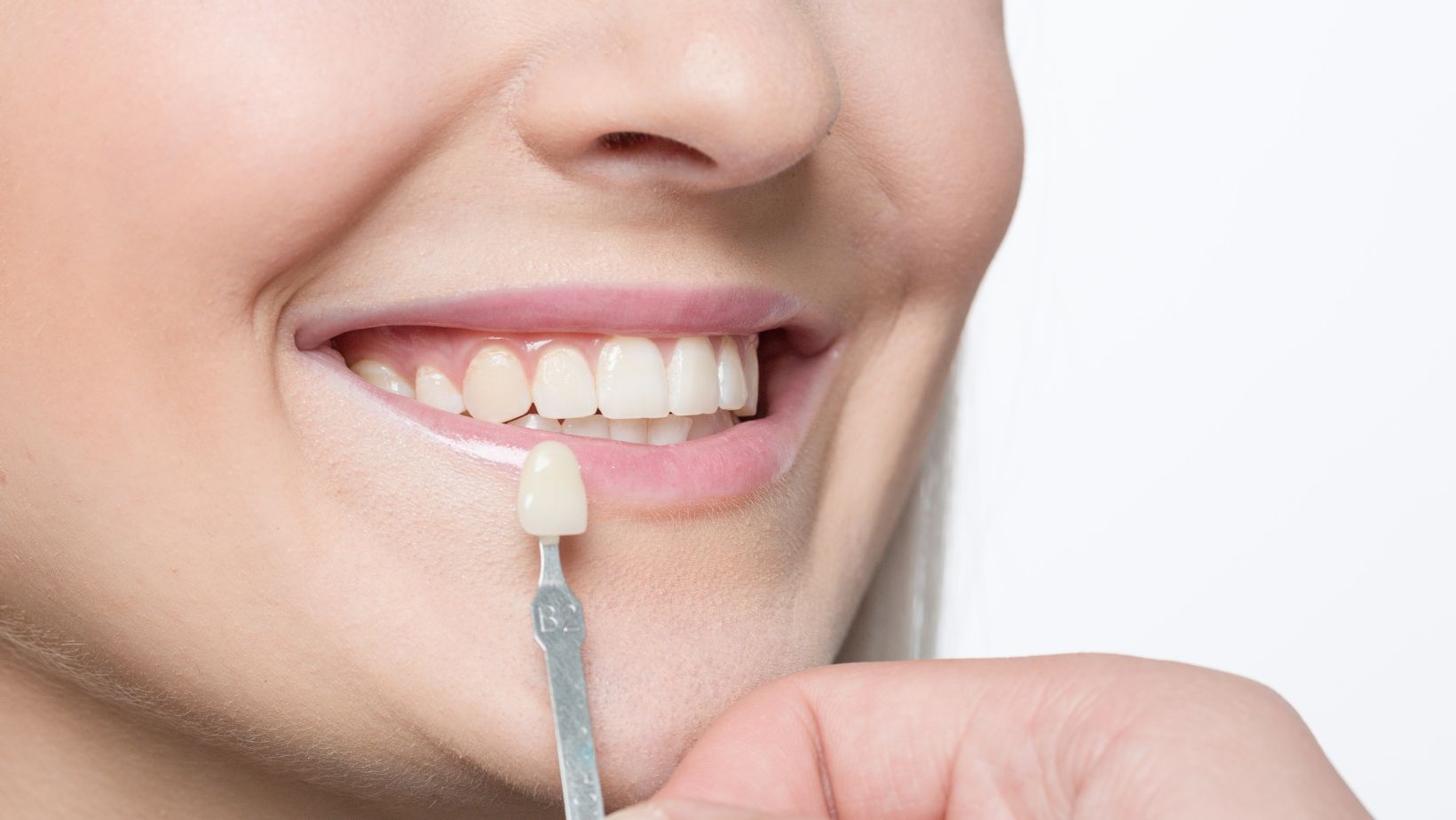 Are Veneers and Bonding the Same Thing?