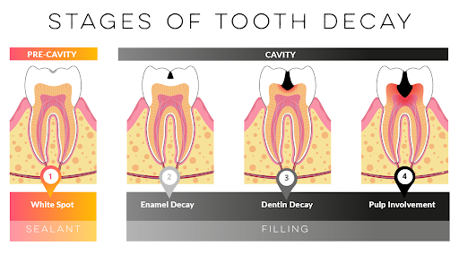 Cavities progress in stages.  Pre-cavities appear as white spots on enamel.  This "Demineralization" amounts to the tooth enamel beginning to dissolve.   
