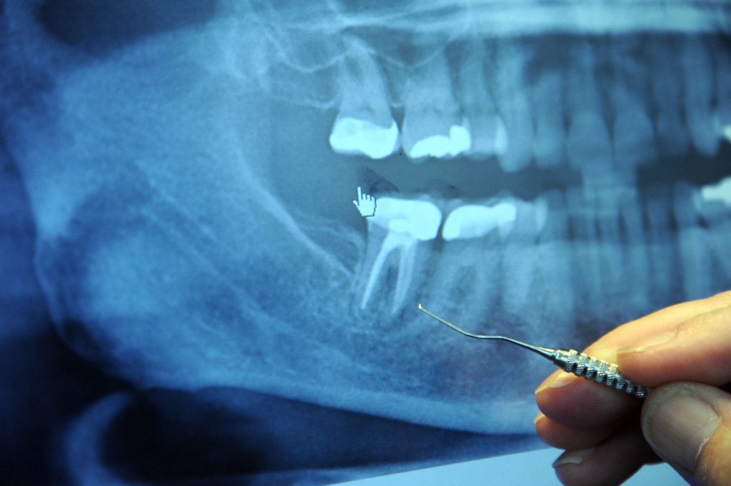 dentist pointing out root that needs root canal