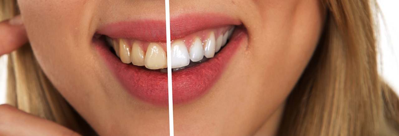 The same smile before and after carbamide peroxide teeth whitening