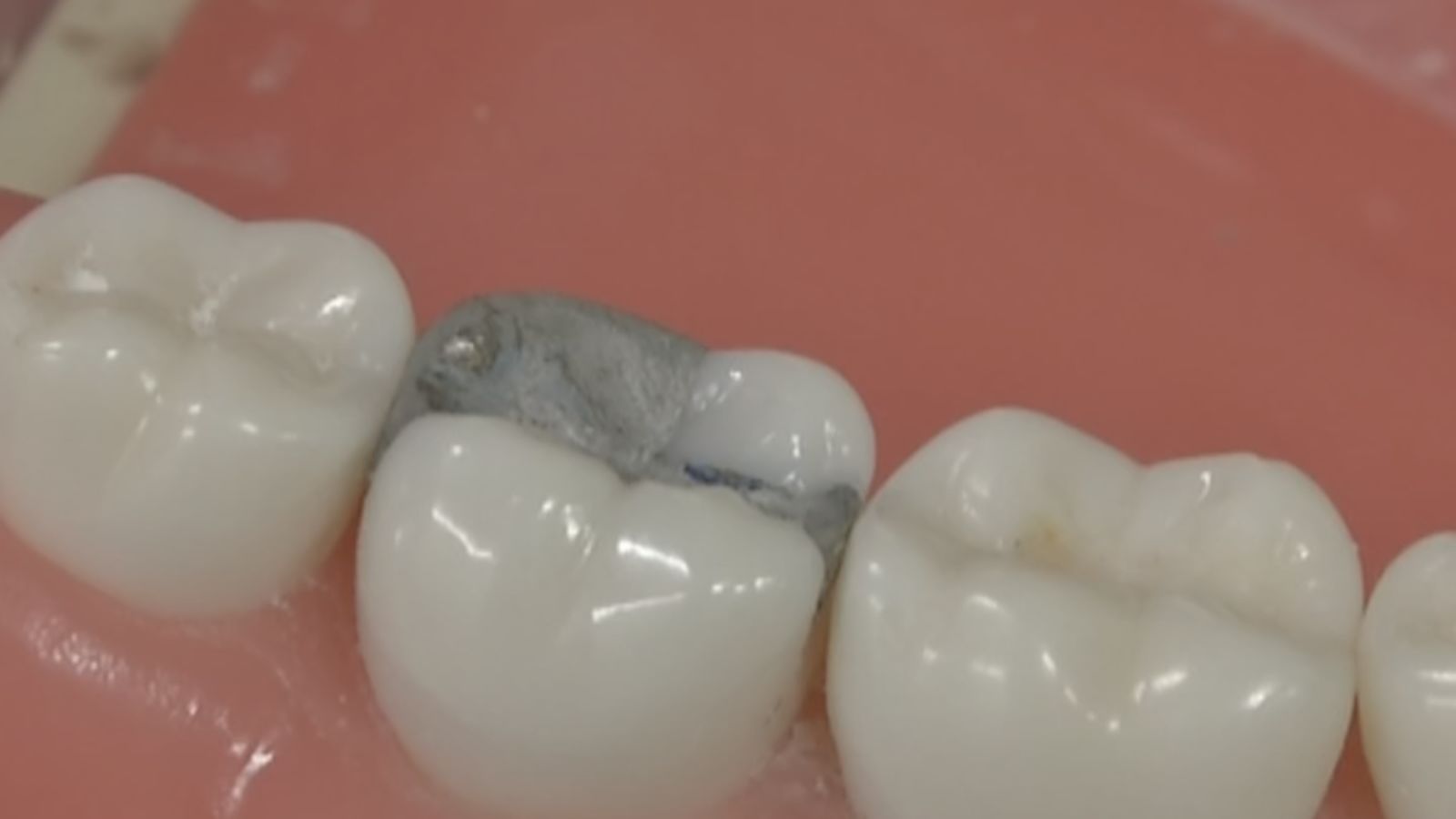 are dental fillings toxic? Here is an example of an amalgam filling in a model of the mouth