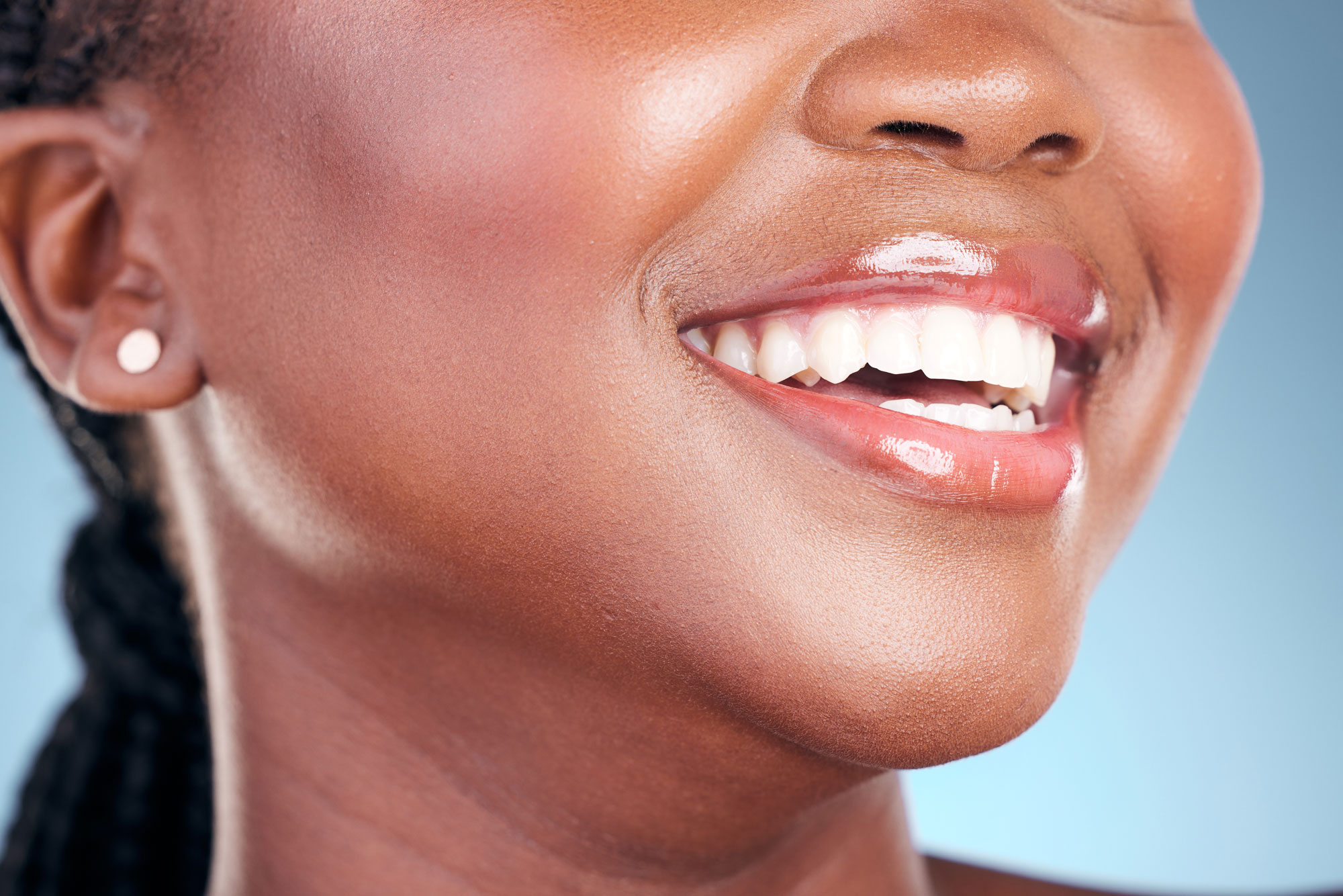 What Are “No-Prep” Veneers?” Are They Too Good to Be True?