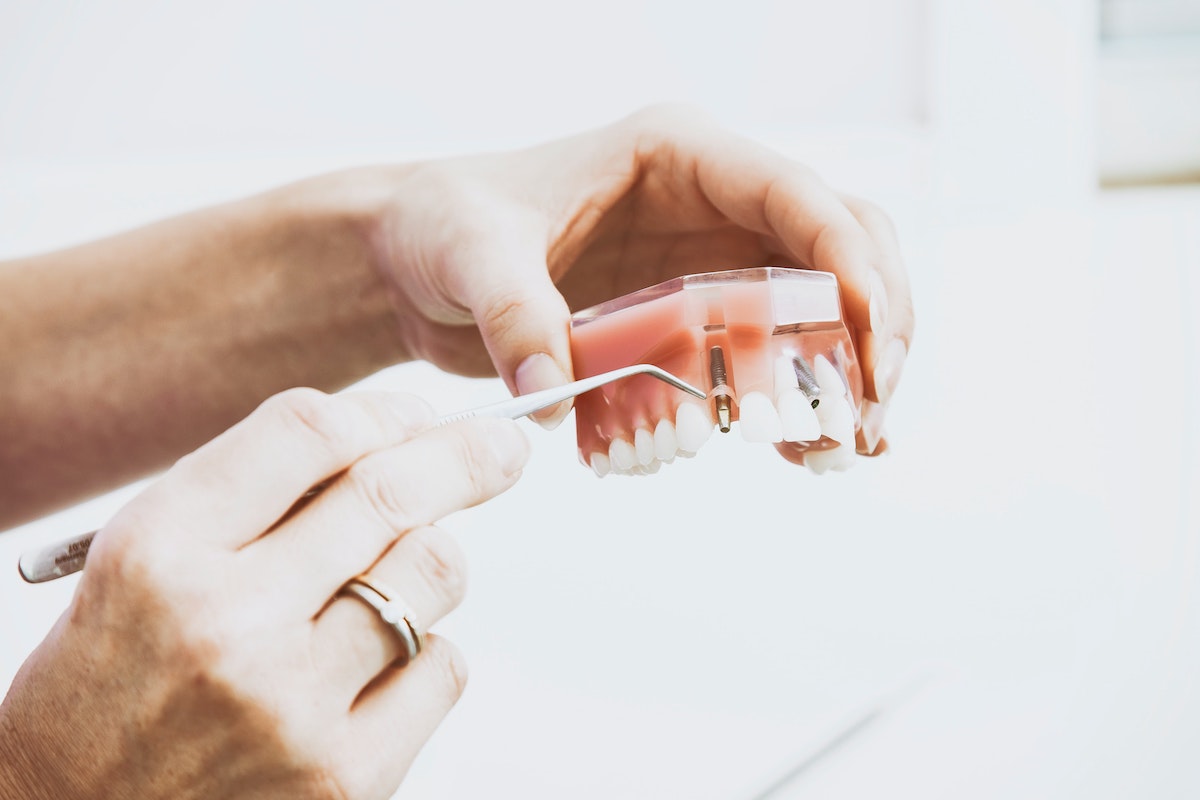 Dental Implants: What are they, and do they work?