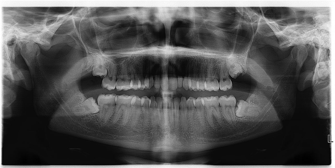 Risks That Come with Wisdom Tooth Extraction