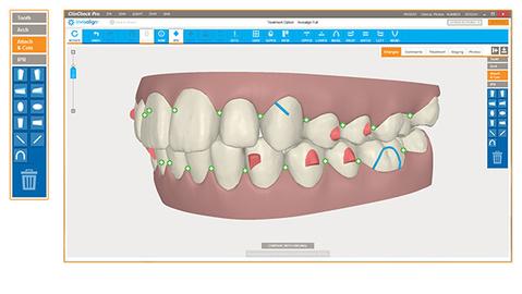 smile direct club vs invisalign vs candid