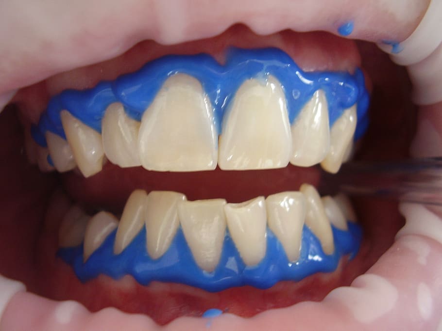 Patient being prepped for teeth whitening at the dentist