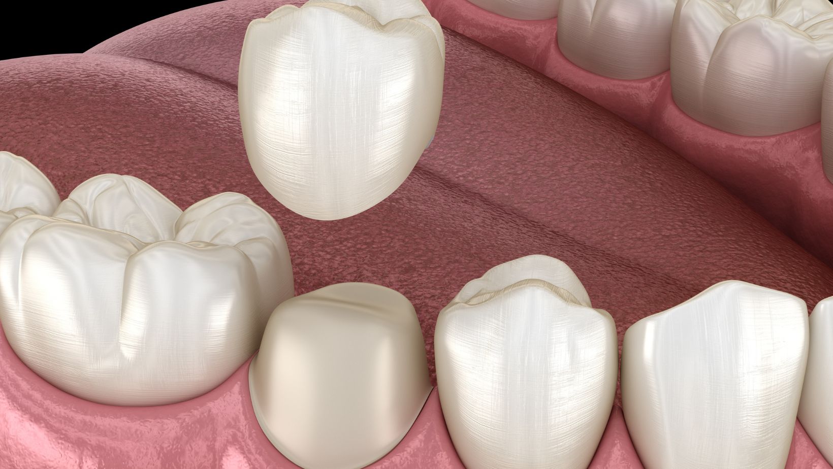 Decay Under Crowns: What to Watch For and How to Fix It