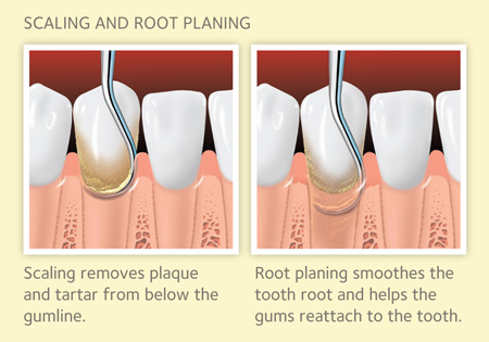 Periodontal Scaling And Root Planingare They Necessary Dental