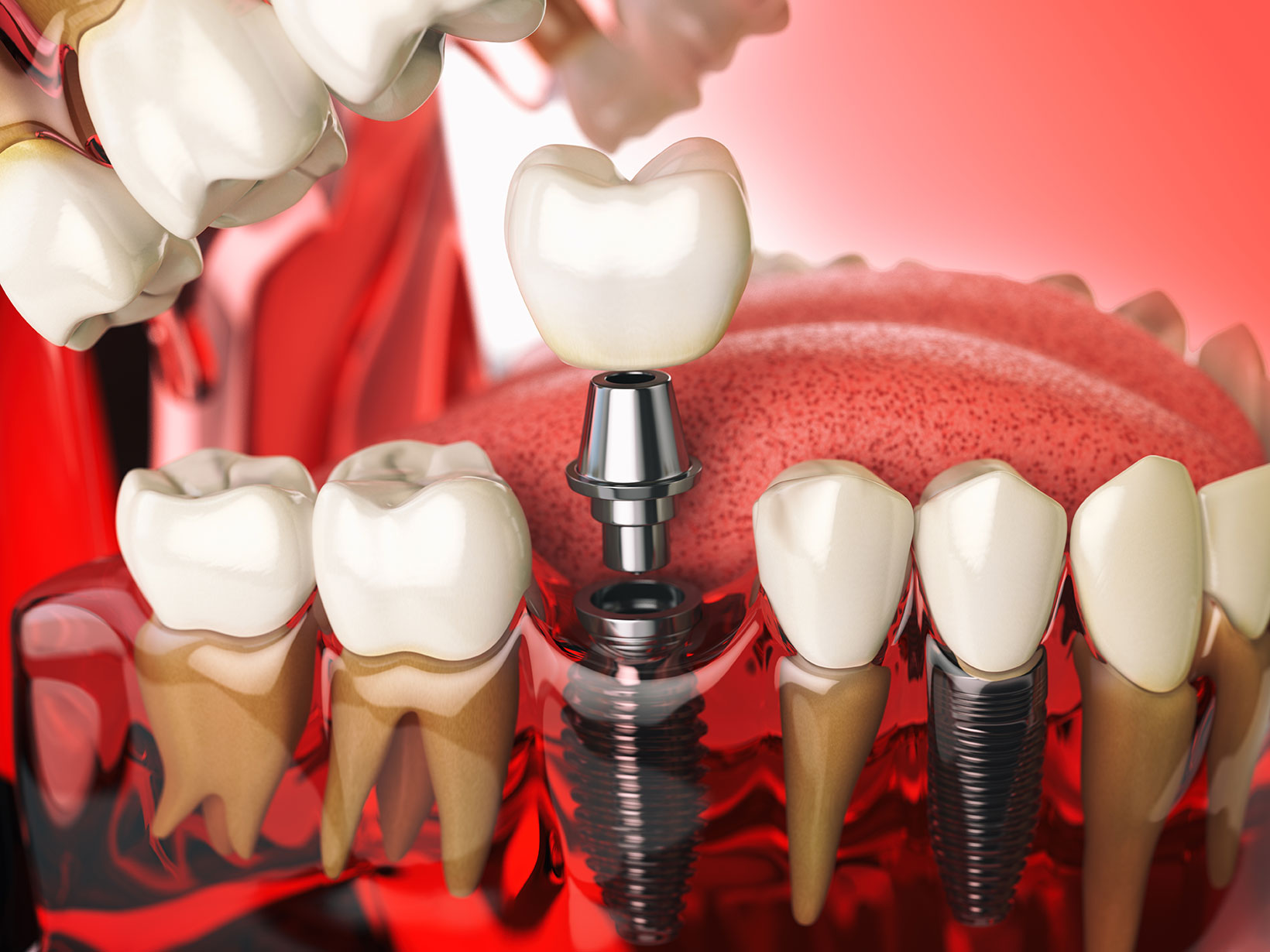 Implant vs. Mini-Implant: What’s the Difference and Which Is Right for You?
