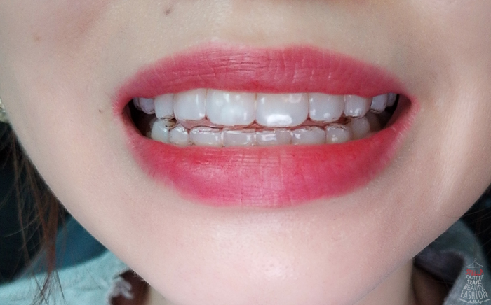 Close-up of woman's mouth wearing Invisalign