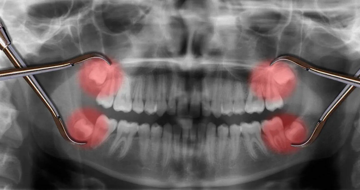 Symptoms of Wisdom Teeth Coming In, and When to See a Dentist