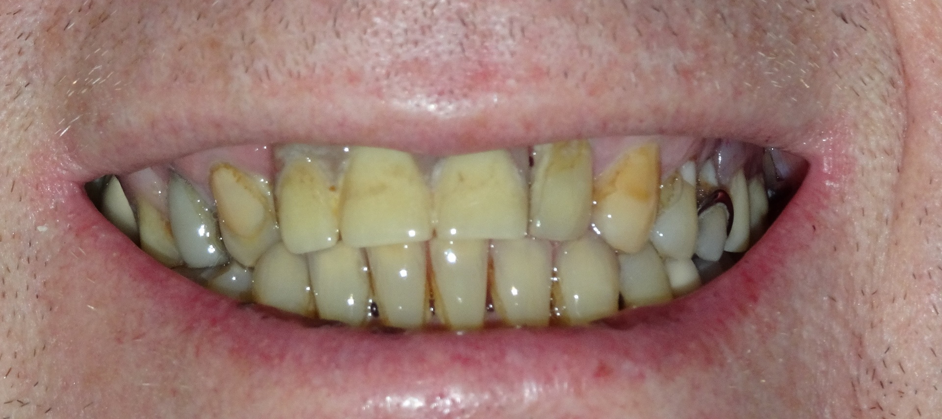 yellowed teeth need professional teeth whitening