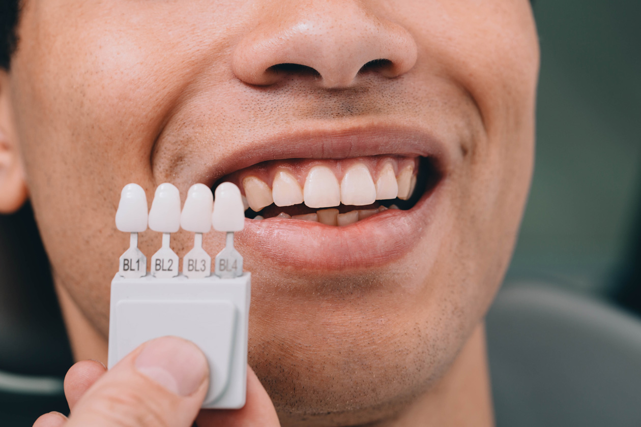 Why Did Whitening Make My Fillings, Crowns, or Veneers Stand Out